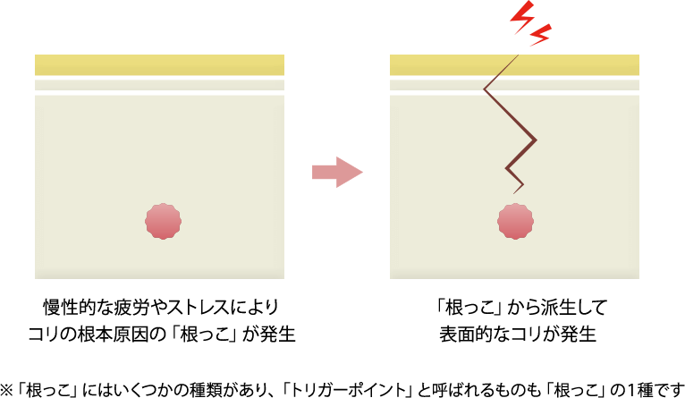 ※「根っこ」にはいくつかの種類があり、「トリガーポイント」と呼ばれるものも「根っこ」の１種です