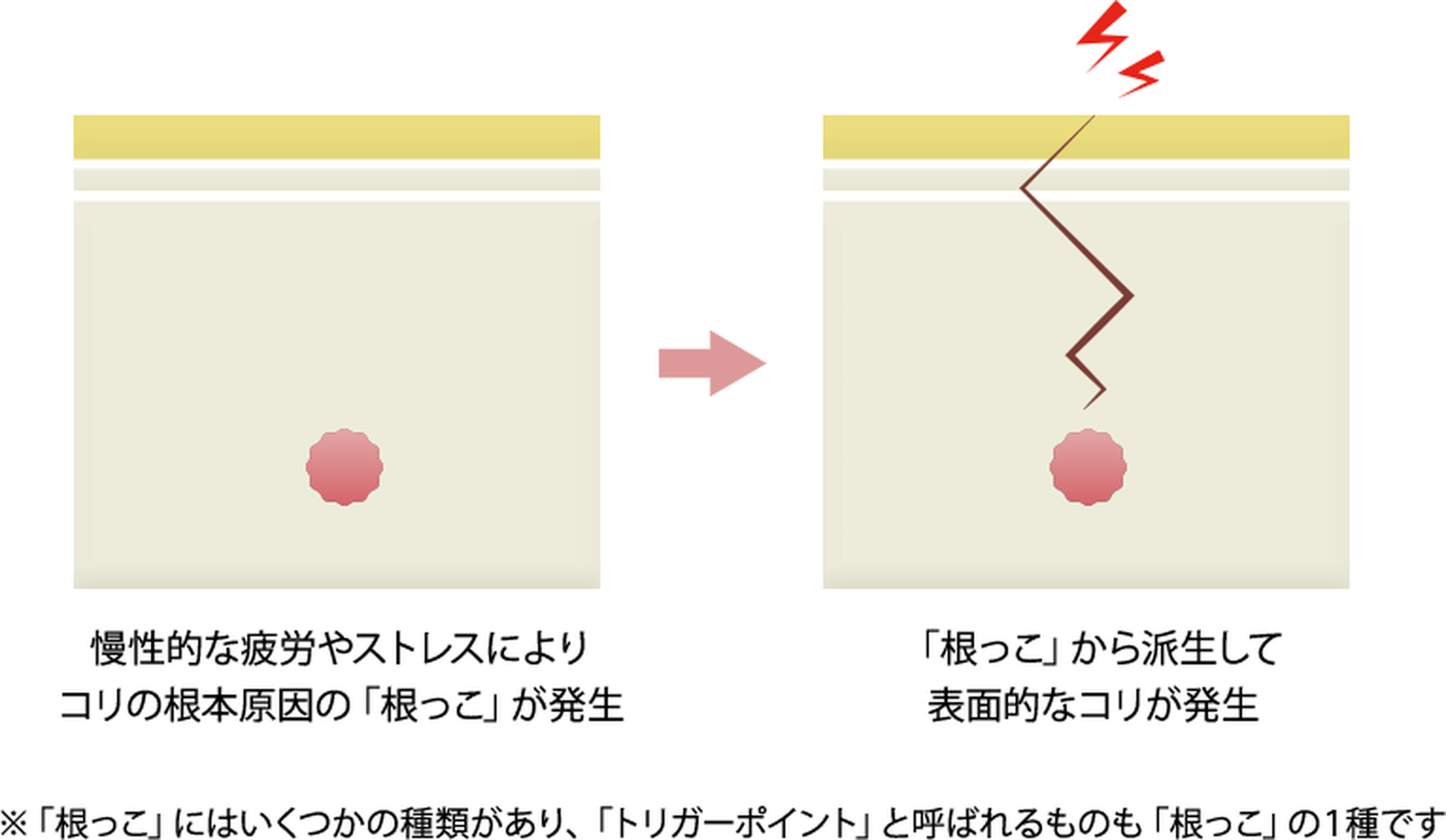 表面的なコリと、その奥にある「コリの根っこ」の関係を示した図